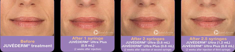 Juvederm Wrinkle Filler